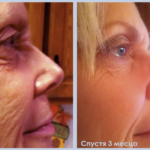 Luminesce rejuvenation serum made by Jeunesseglobal (before-and-after pictures)