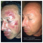 Luminesce Rejuvenation serum made by Jeunesseglobal (before-and-after pictures)