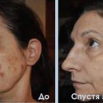 Luminesce serum by Jeunesseglobal (before-and-after pictures)