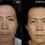 Luminesce serum by Jeunesseglobal (before-and-after pictures)