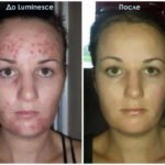 Luminesce serum by Jeunesseglobal (before-and-after pictures)