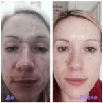 Luminesce cosmetics by Jeunesseglobal (before-and-after)