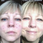 Luminesce cosmetics by Jeunesseglobal (before-and-after)