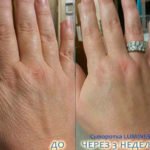 Luminesce serum by Jeunesse (before-and-after pictures) for hands