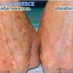 Jeunesse Luminesce serum for hand spots (before-and-after pictures)