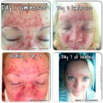 Сыворотка Jeunesse Luminesce лечит повреждённую кожу - фото до и после
