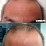 Luminesce serum by Jeunesse (before-and-after pictures) for hair growth