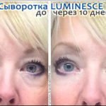 Сыворотка Luminesce от тёмных кругов под глазами - фото до и после