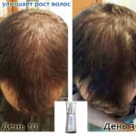 Luminesce serum by Jeunesse (before-and-after pictures) for hair growth