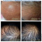 Luminesce serum by Jeunesse (before-and-after pictures) for hair growth