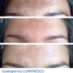 Сыворотка Luminesce от пигментных пятен - фото до и после