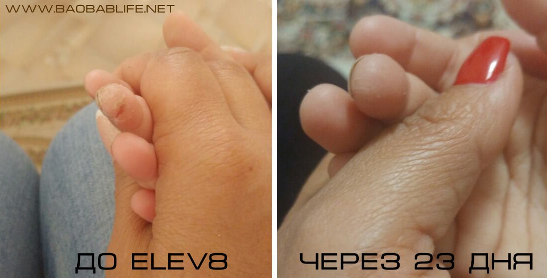 кожная болезнь у ребёнка Elev8